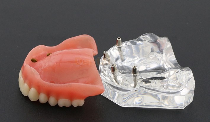 Dental Teeth Implant Overdenture Model Upper Jaw With 4 Implants Study Demo Model 6001